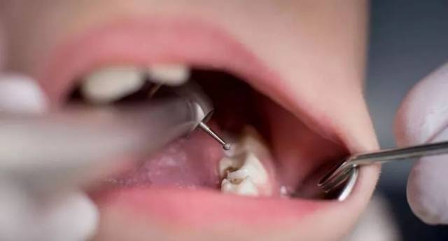 چگونه مانع پوسیدگی دندان شیرخواران شویم؟